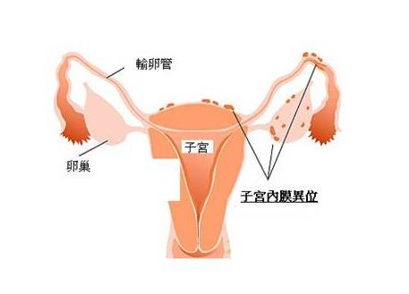 子宫腺肌症最新治疗，自然美景的心灵探索之旅