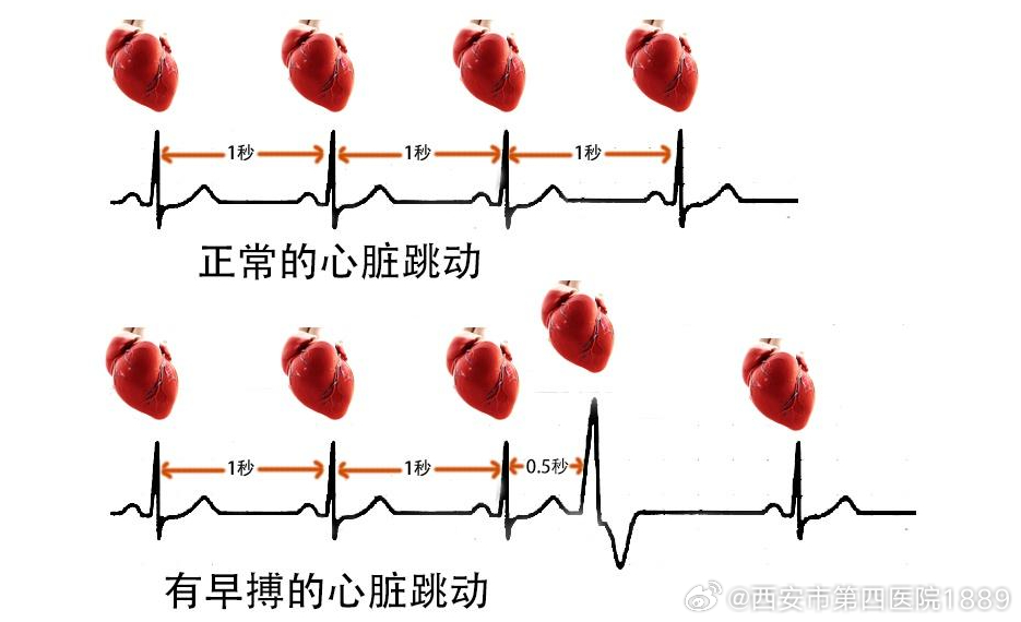 最新早搏现象解读与观点阐述