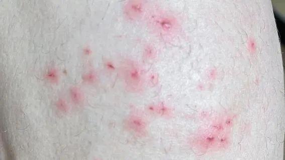 德国出现首例猴痘病毒新变种病例