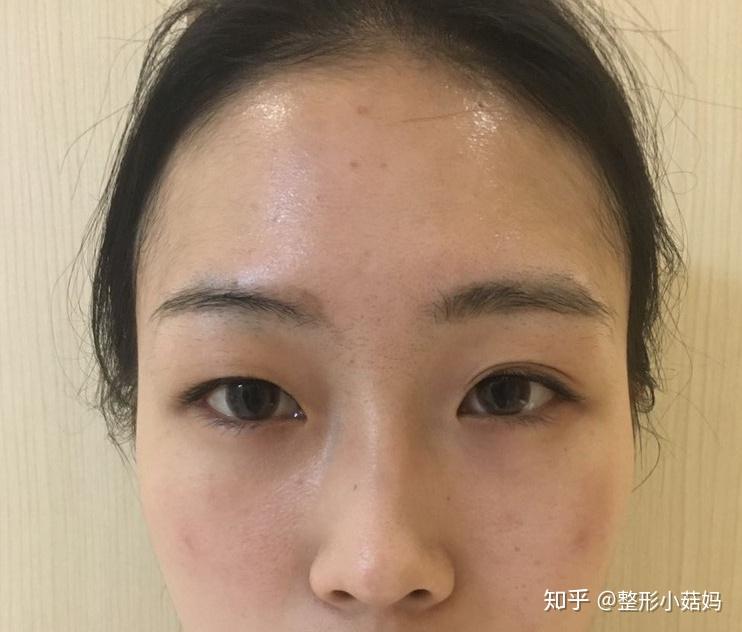 双眼皮的喜好，审美差异下的选择？