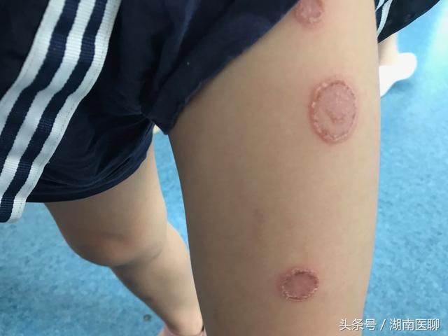 女子频繁逛猫咖染宠物癣，预防与应对指南