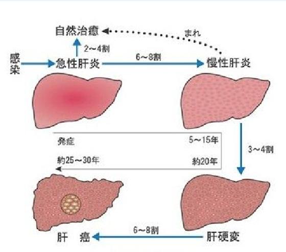 肝病最新疗法,肝病最新疗法论述