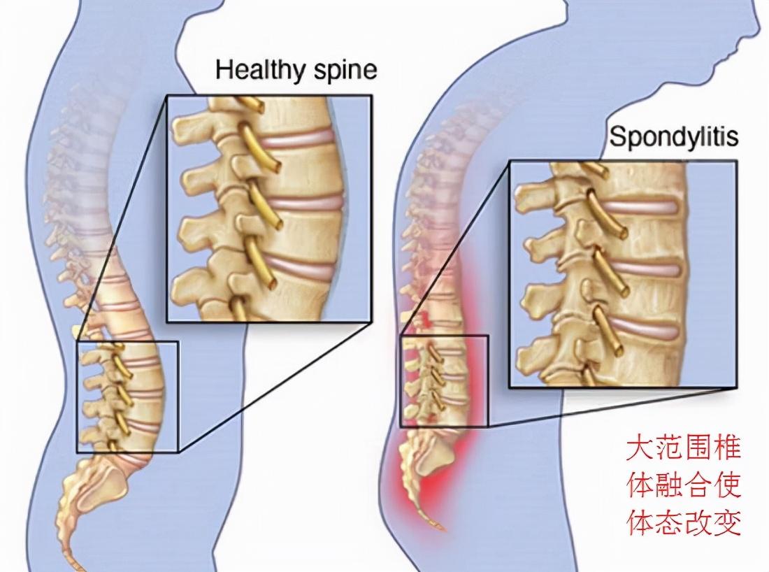强直性脊柱炎最新治疗办法,强直性脊柱炎最新治疗办法