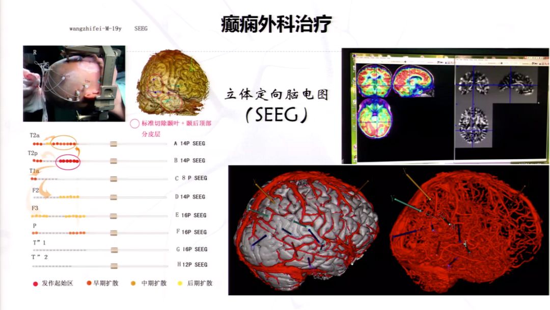 神经痛最新研究进展与发展动态分析